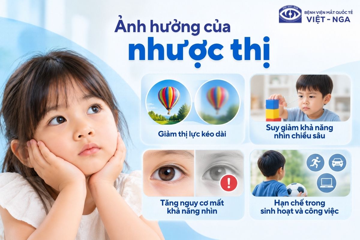 Nhược thị kéo dài có thể làm mất khả năng nhìn chiều sâu và suy giảm thị lực vĩnh viễn ở tuổi trưởng thành.