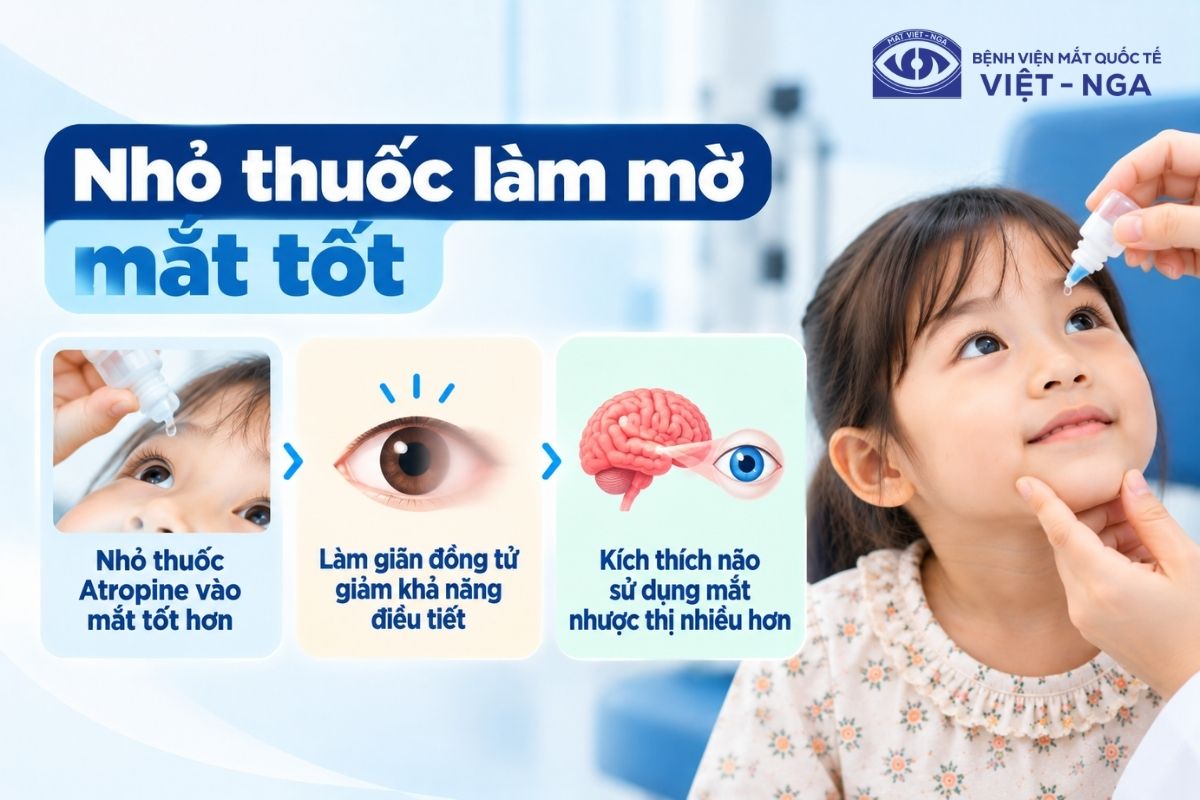 Nhỏ thuốc Atropine làm mờ tạm thời mắt khỏe, giải pháp thay thế hiệu quả khi trẻ không hợp tác đeo miếng che.
