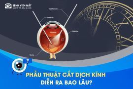 Phẫu thuật cắt dịch kính diễn ra trong bao lâu?