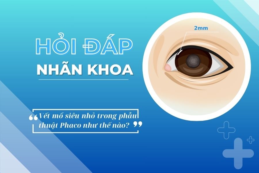 Hỏi đáp nhãn khoa: Vết mổ siêu nhỏ trong phẫu thuật Phaco như thế nào?