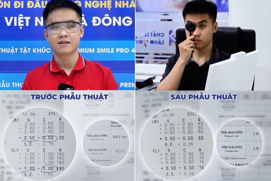 Gen Z lựa chọn Super Smile Pro: Thị lực cải thiện từ 0.5/10 lên 10/10 sau phẫu thuật