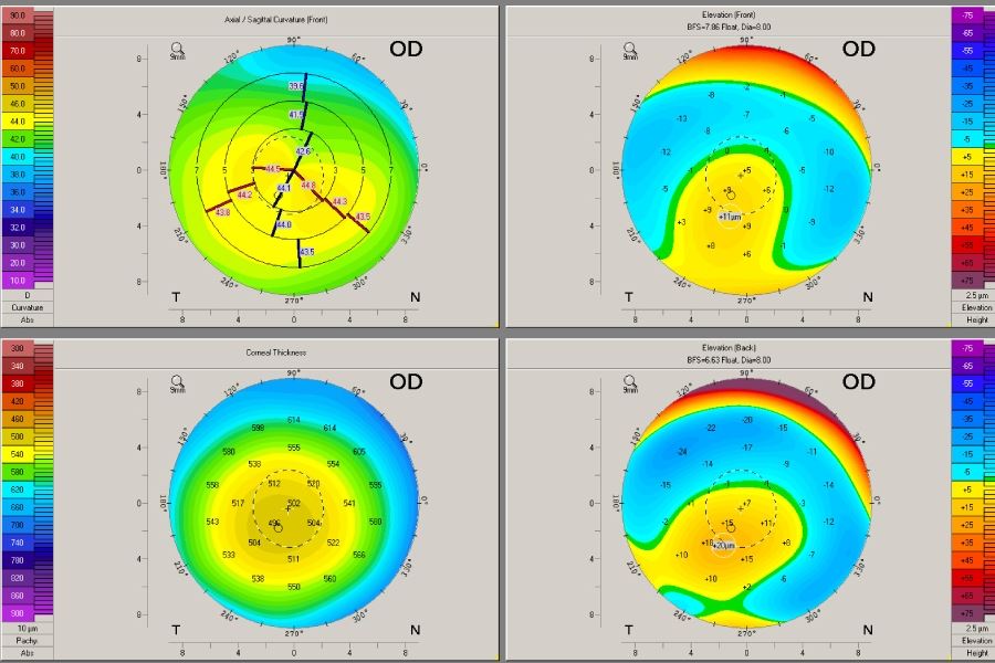 Bản đồ giác mạc là gì? Tại sao cần chụp bản đồ giác mạc trước xóa cận