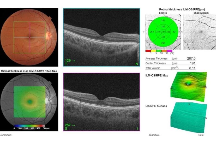 Chụp cắt lớp võng mạc mắt để làm gì?