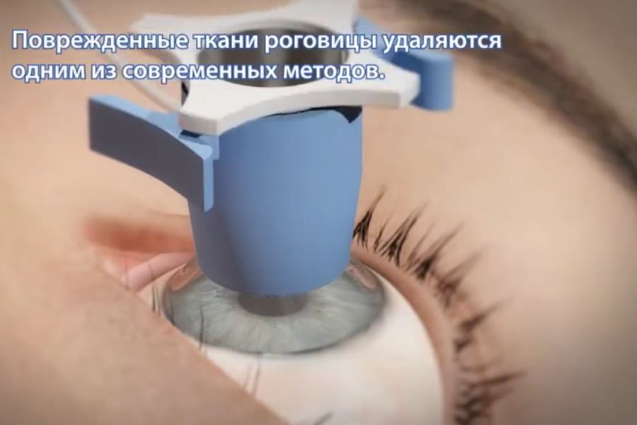 Ghép giác mạc là gì? Vì sao cần ghép giác mạc