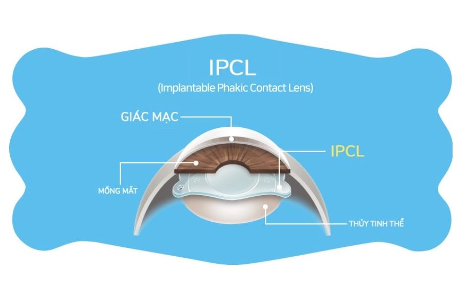 Thấu kính nội nhãn IPCL - Giải phóng tầm nhìn cho người có độ khúc xạ cực cao