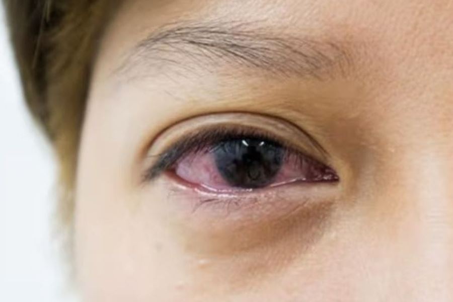 Những nguyên nhân âm thầm gây viêm giác mạc, thói quen cuối ai cũng dễ mắc