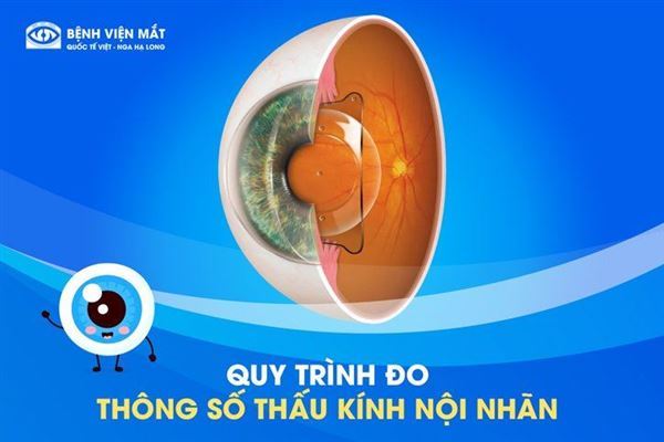 Quy trình khám chuyên sâu đo thông số thấu kính nội nhãn ICL