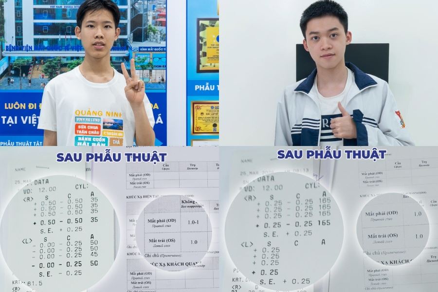 Phẫu thuật Super Smile Pro, hai nam sinh cận hơn 5 độ đủ tiêu chuẩn thị lực 10/10 thi quân đội