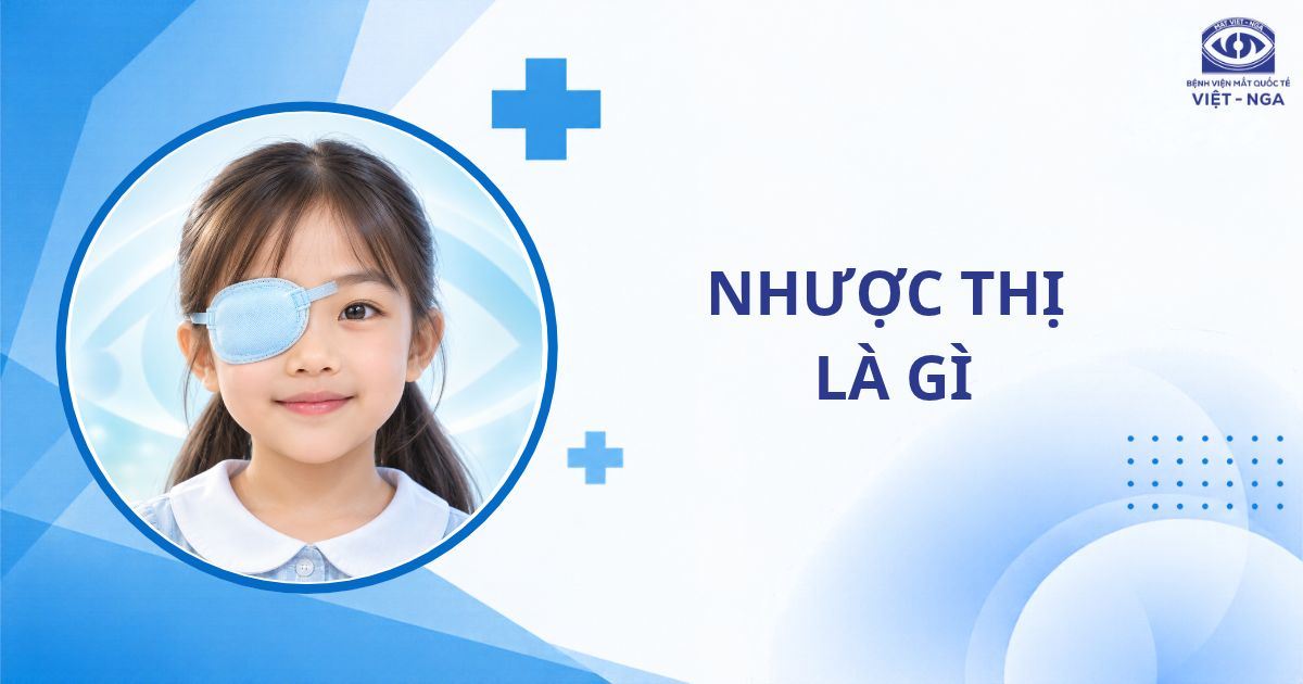 Nhược thị là gì? Những điều cha mẹ cần biết để bảo vệ thị lực của trẻ