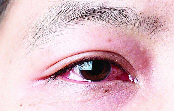 Bệnh mắt hột lây lan thế nào? 
