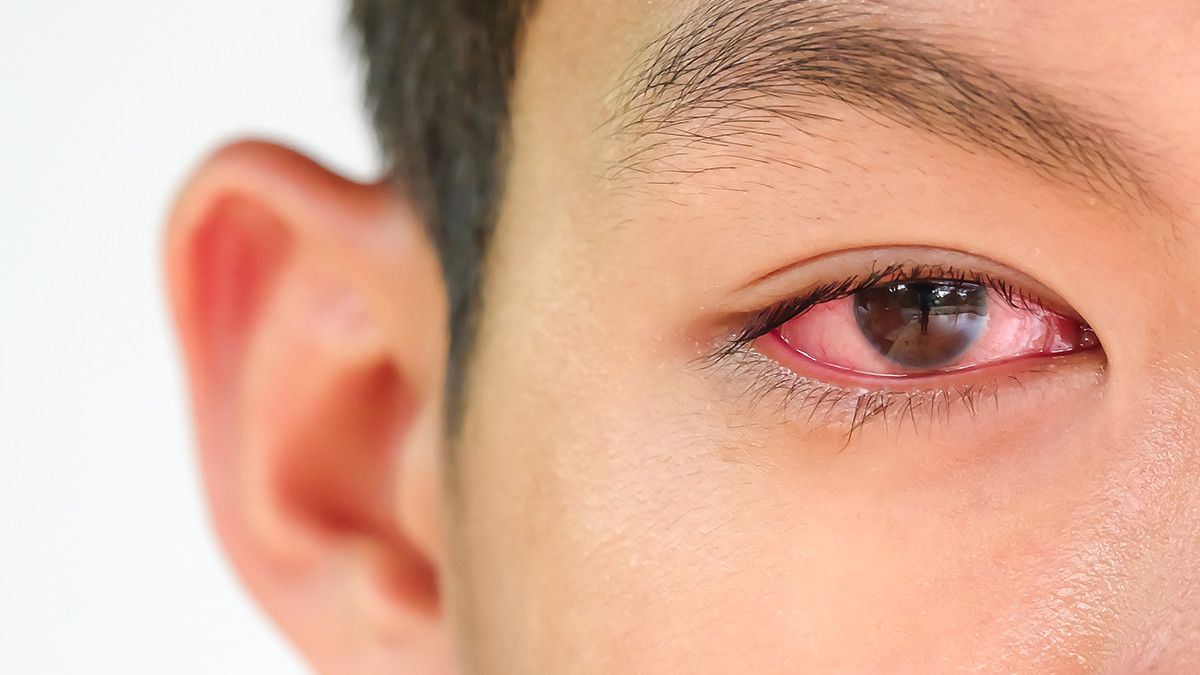 Tổng quan về bệnh Viêm kết mạc (đau mắt đỏ)